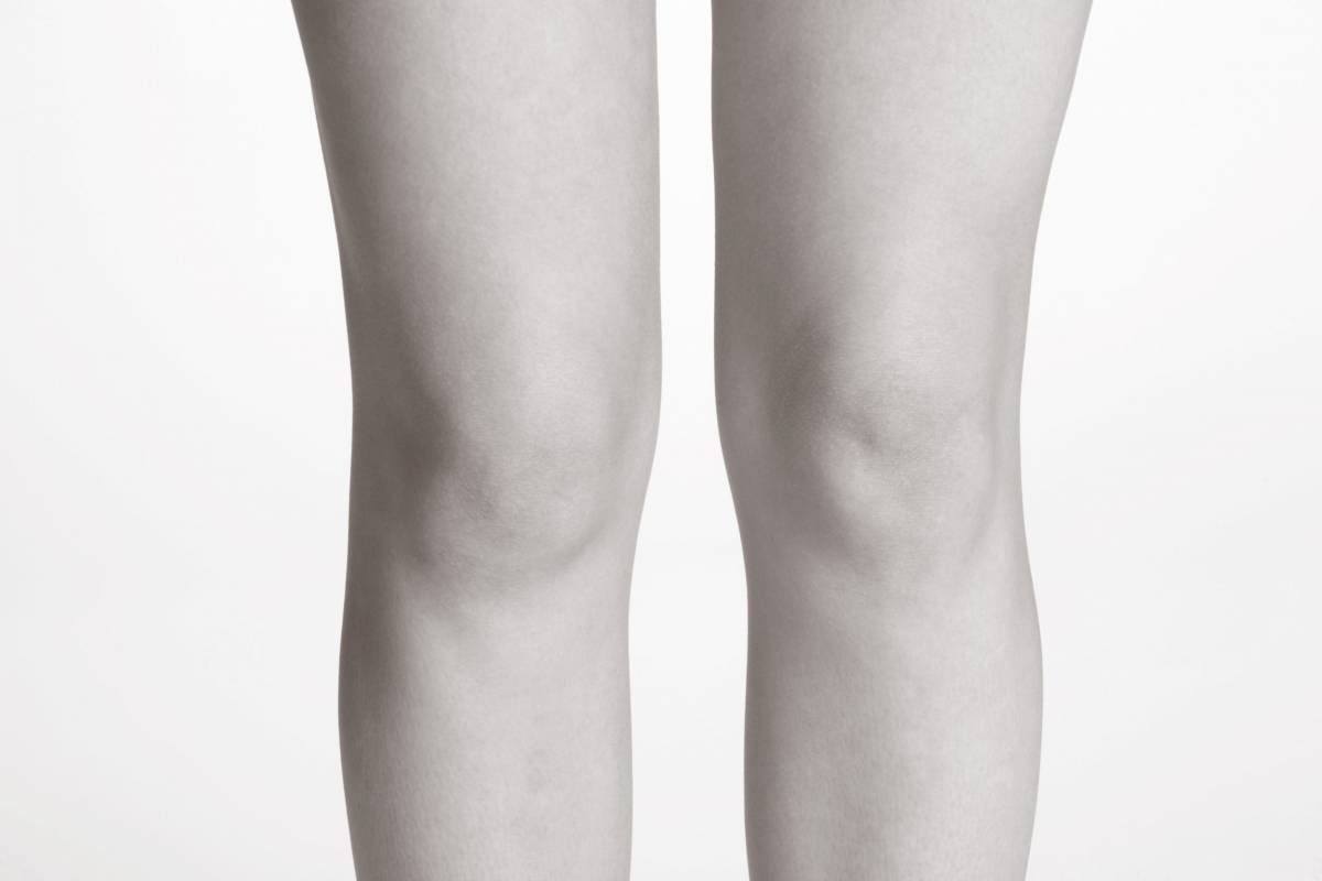 Liposuccion des genoux - Dr Hamou