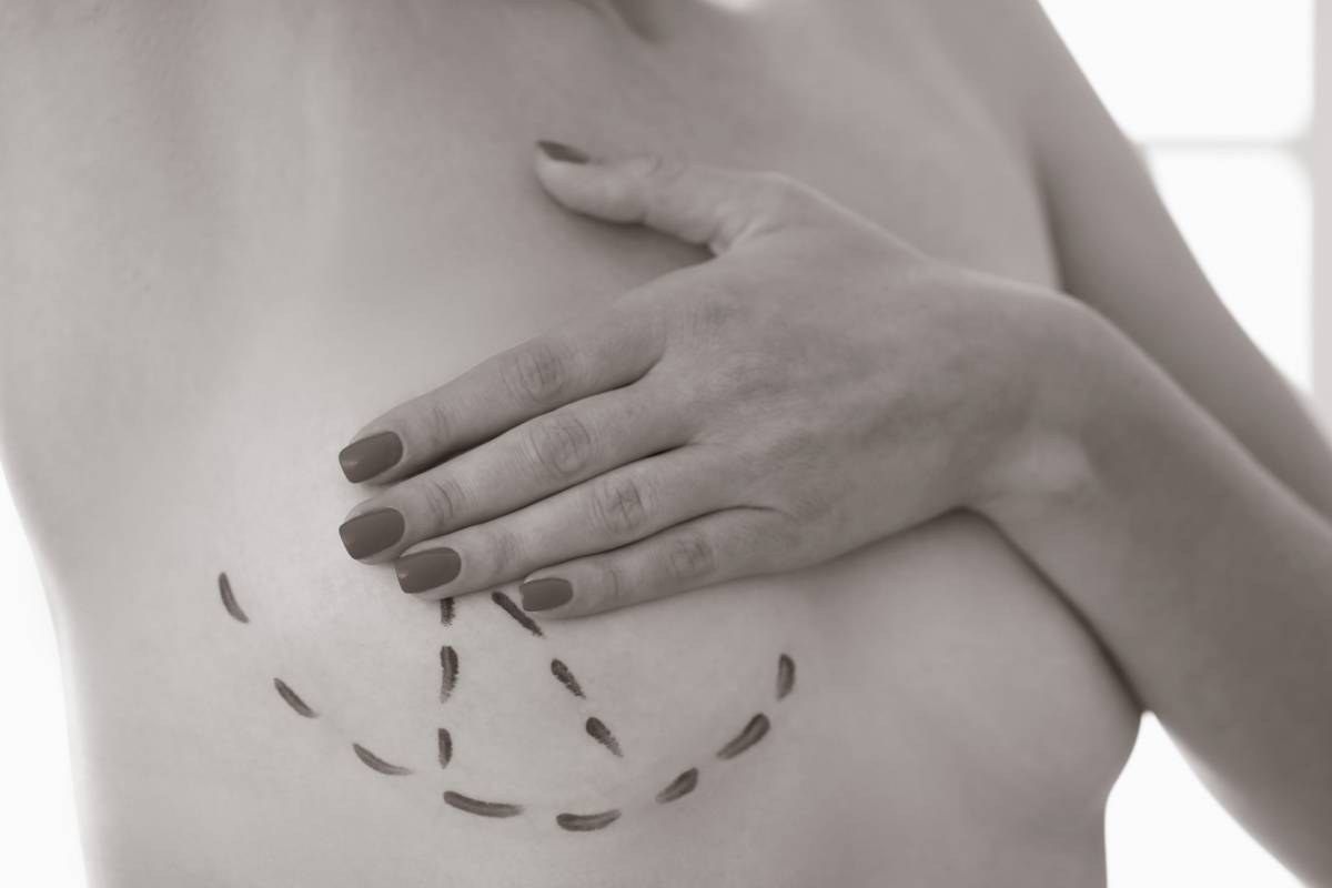  reconstruction mammaire lipomodelage - Dr Hamou