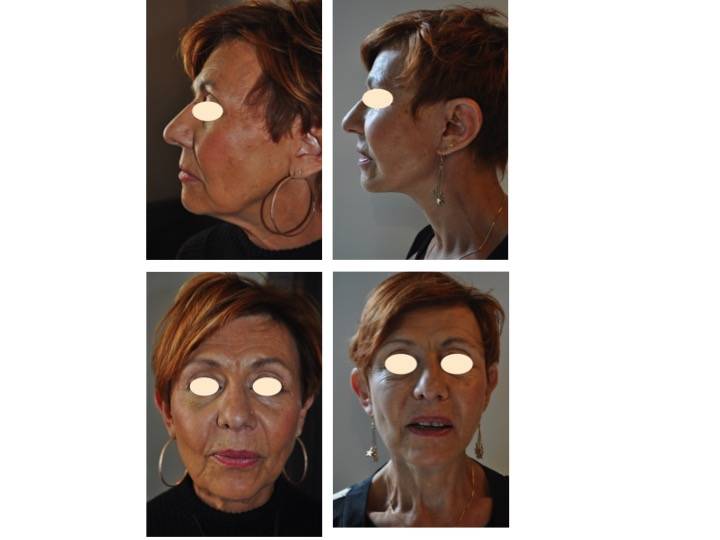 Le Lifting Cervico Facial Au Naturel Dr Cynthia Hamou