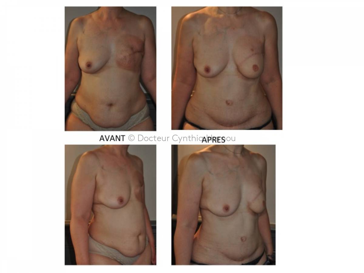 Reconstruction mammaire par lambeau abdominal DIEP avant après - Dr Hamou